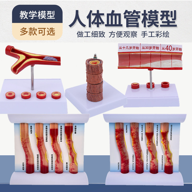 教学人体堵塞血管动支脉粥样/硬化心血管动脉/ 血管病理血栓模型