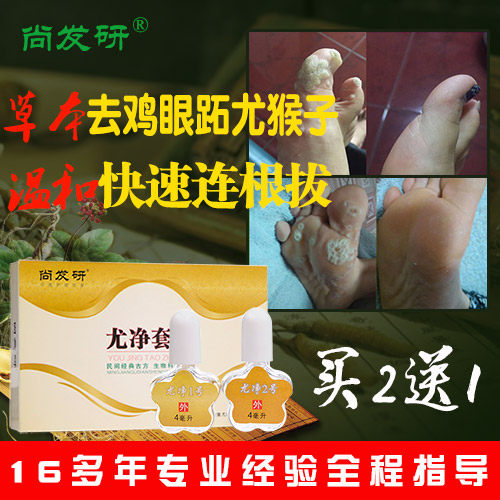 尚发研跖疣专用鸡眼膏贴鸡尤净肉刺去疣灵足部趾疣脚底