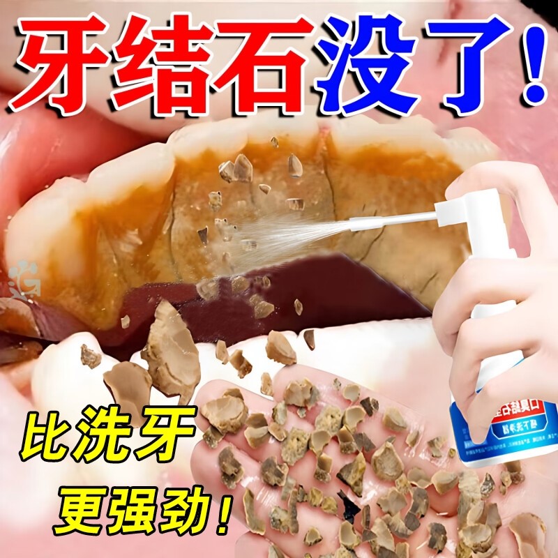 【香港国医】牙结石溶解喷剂医用去牙结石溶解牙石速效清理去除器