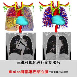 Mimics3D打印重建:肺部淋巴结心脏血管DICOM/STL三维重建服务