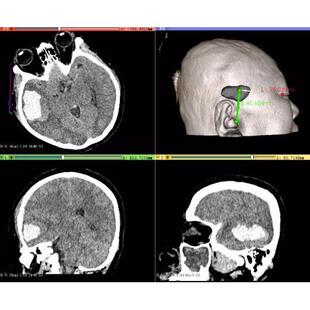 全身各部位影像数据(四肢骨、肝胆、心胸、泌尿)三维重建3D打印