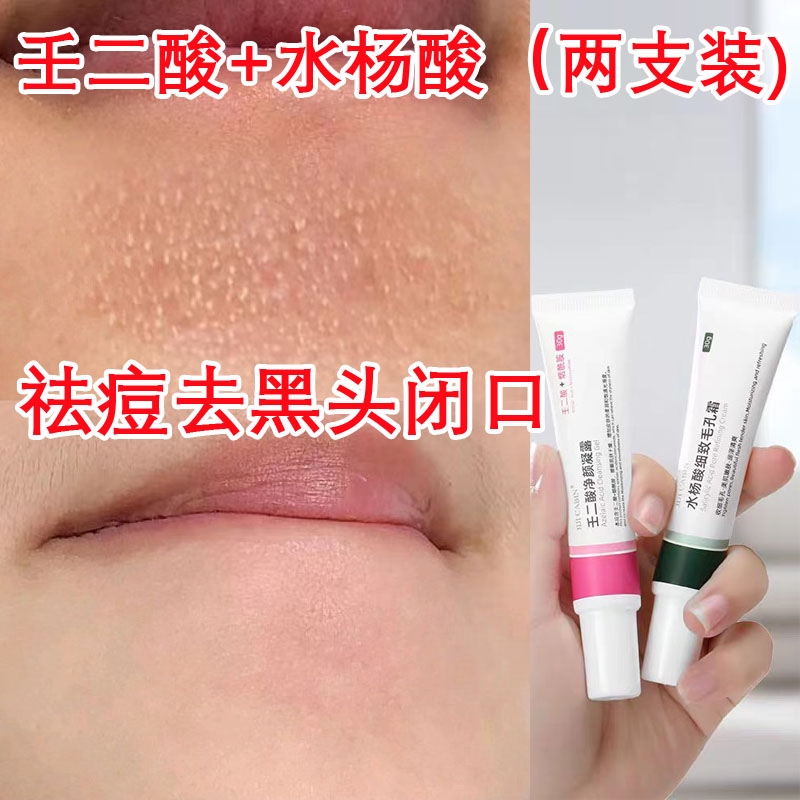 壬二酸凝胶15%水杨酸净颜凝露去黑头收缩毛孔霜去粉刺祛痘膏两只
