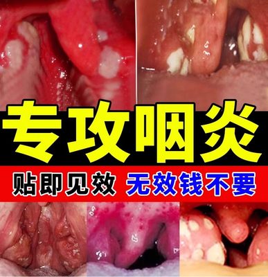 已帮助65536人解决慢性咽炎问题