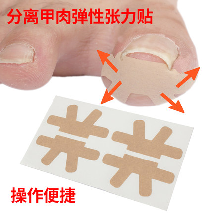 一次性免胶水甲沟物理矫正拉拉贴甲沟纠正贴趾甲炎矫正嵌甲贴