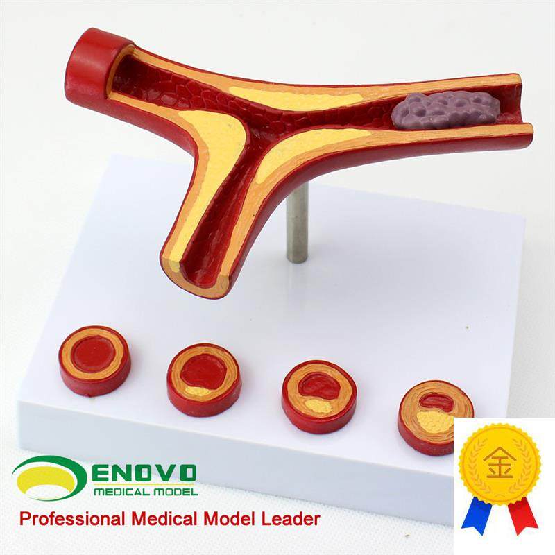 颐诺正品冠状动脉性心血管动脉硬化模型老年心脏模Z型血栓形成