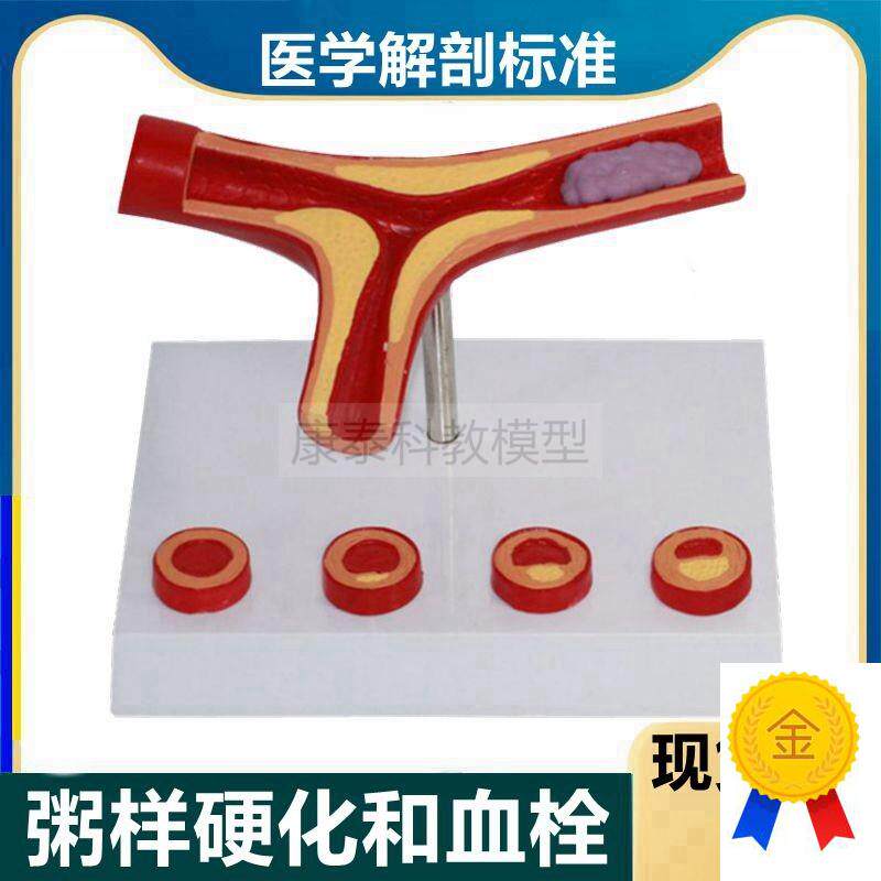 动脉血管模型粥样阻塞硬化狭窄栓子脂肪斑块病理血管内.膜不同年