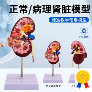 人体病变肾上腺模型肾脏解剖模B型肾模型生殖泌尿科肾病理模型