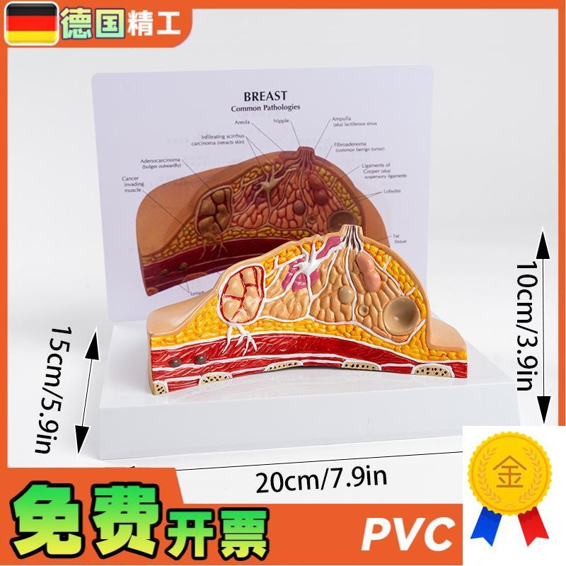 德国】PNT-0741乳房病理x模型女性乳房病理医学教学模型妇科教学