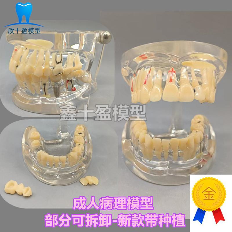 牙科牙齿病理模型成人全口牙模型牙模医H患沟通教育教学种植修复C