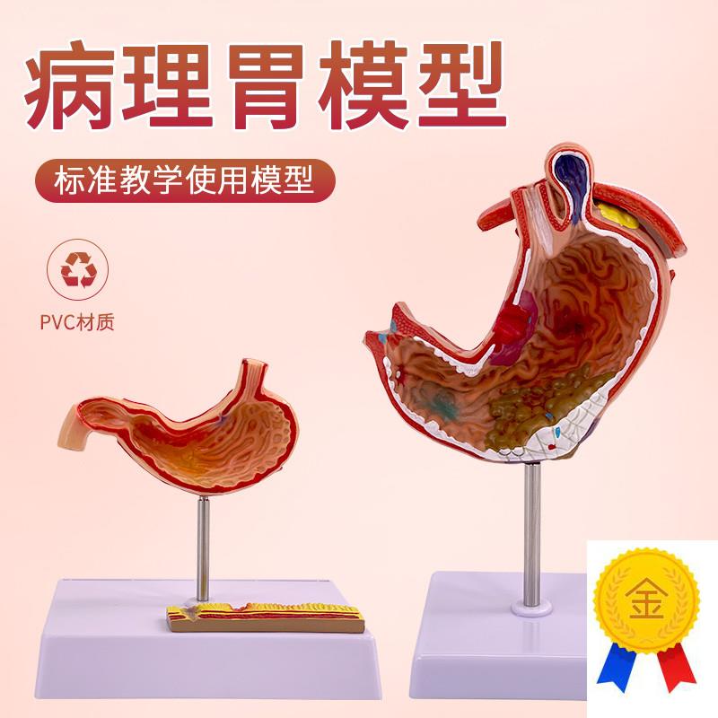 病理胃模型人体胃的穿孔病态胃模型消化科胃R冠状剖面解剖放大