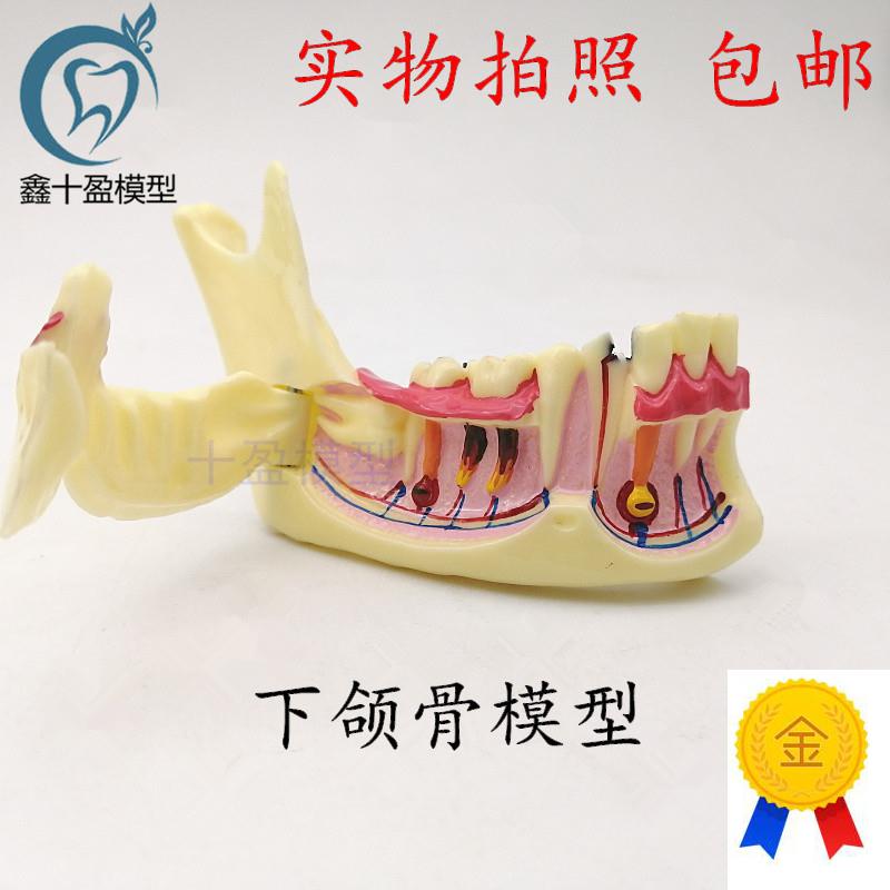 牙科下颌骨组织分解模型半侧可打开根部龋坏牙P齿分解模型4014