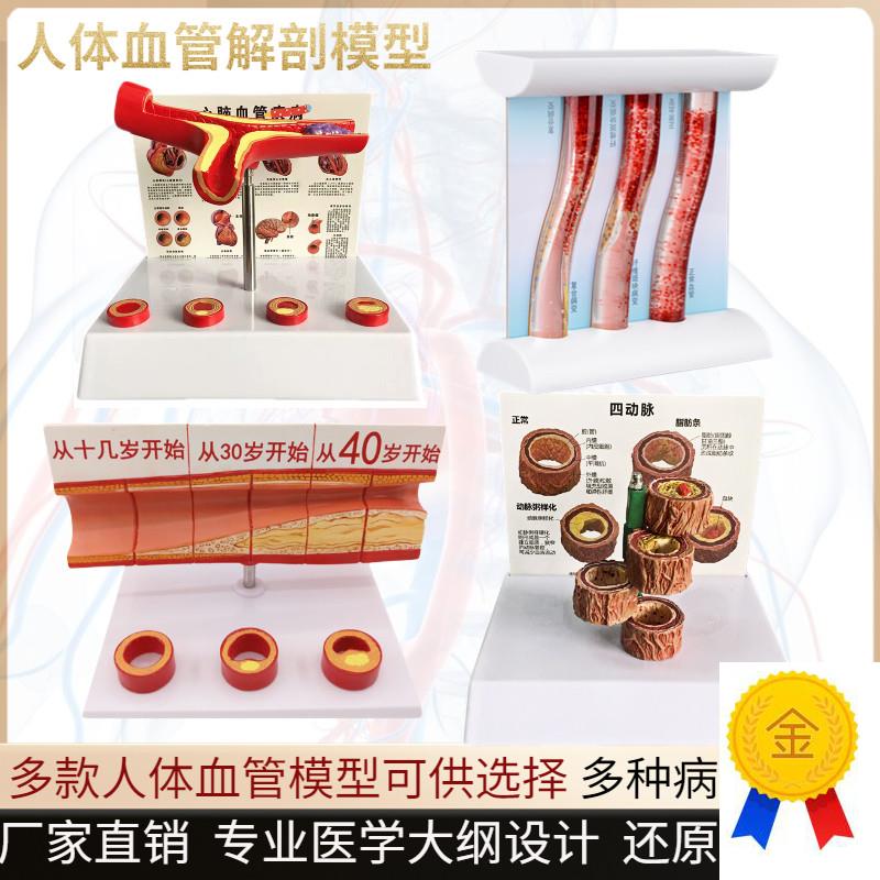 血管堵塞动支脉粥样硬化心血管动脉硬化模型血管S病理动态血栓模