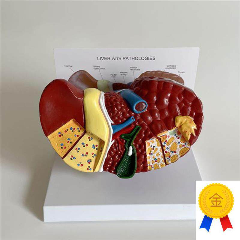 病理肝脏模型胆囊肝n门静脉脂肪酒精炎肝脏医药促销医患胆总管肝