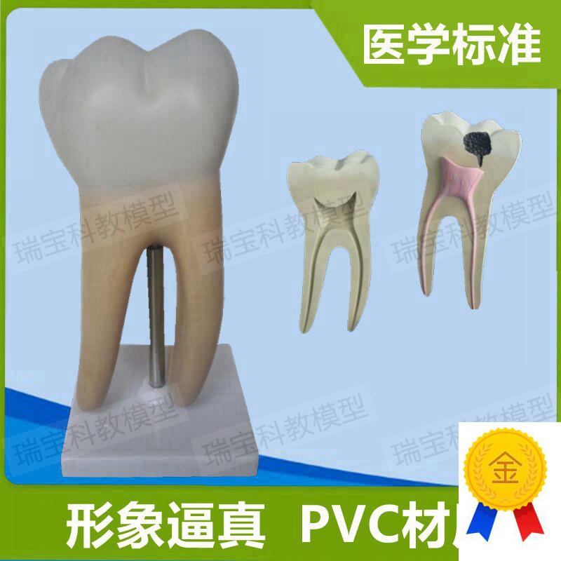 大型磨牙模型可拆卸牙根牙v髓腔蛀牙口腔健科普牙科医生教学器材