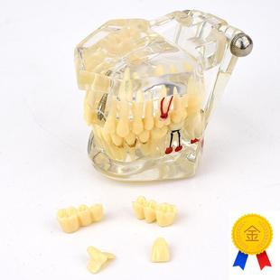 ENOVO颐诺口腔模型齿科种植阻生齿牙体牙髓口腔S教学马里兰桥瓷贴