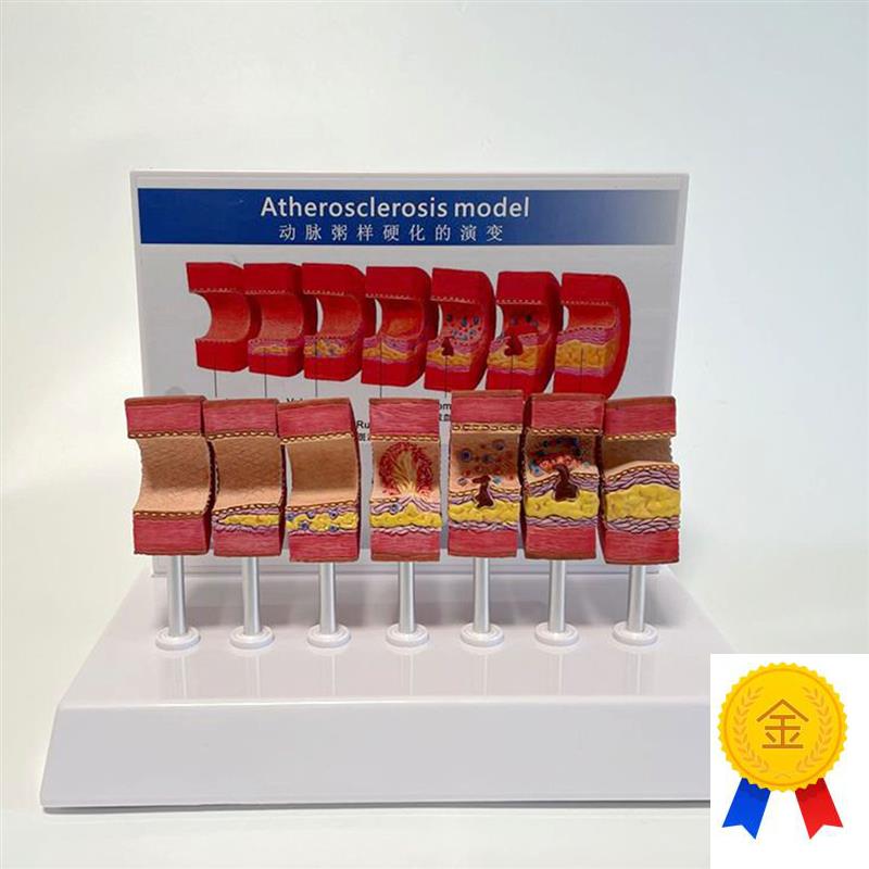 动脉血管模型粥样病理硬化血管壁变细F狭窄内膜斑块沉积阻塞程度