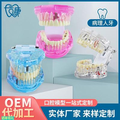 牙齿模型病理修复可拆卸正畸口腔病理牙模型牙科医患活动沟通