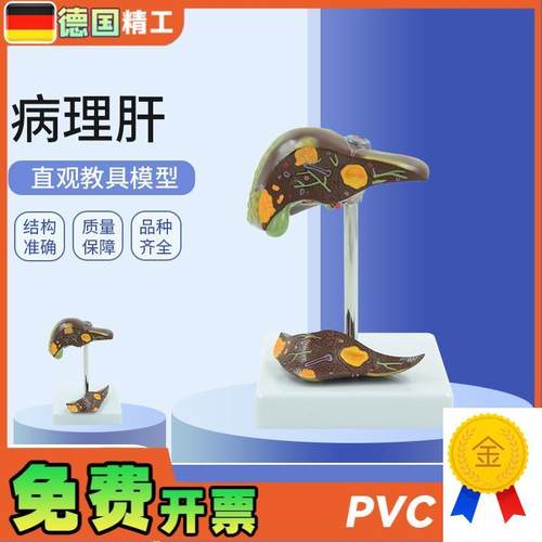 德国】肝脏病理病理肝模x型结石胆模型肝演示病理胆囊