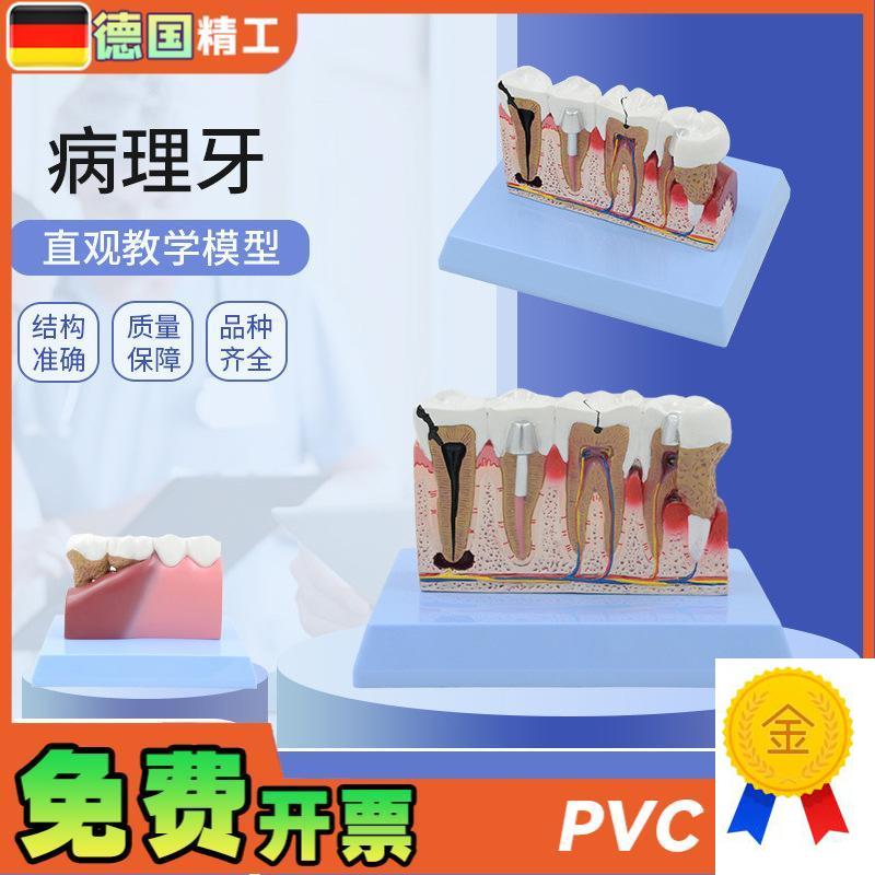 德国牙齿牙科病理学医学教学沟通模型解剖放大病理U演示牙科模型