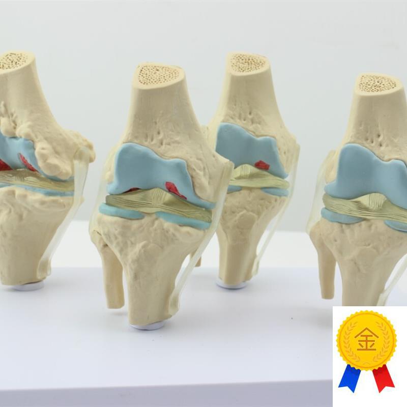 ENOVO颐诺人体病理膝关节模型退行性I血友病模型骨科管骨骼模型膝