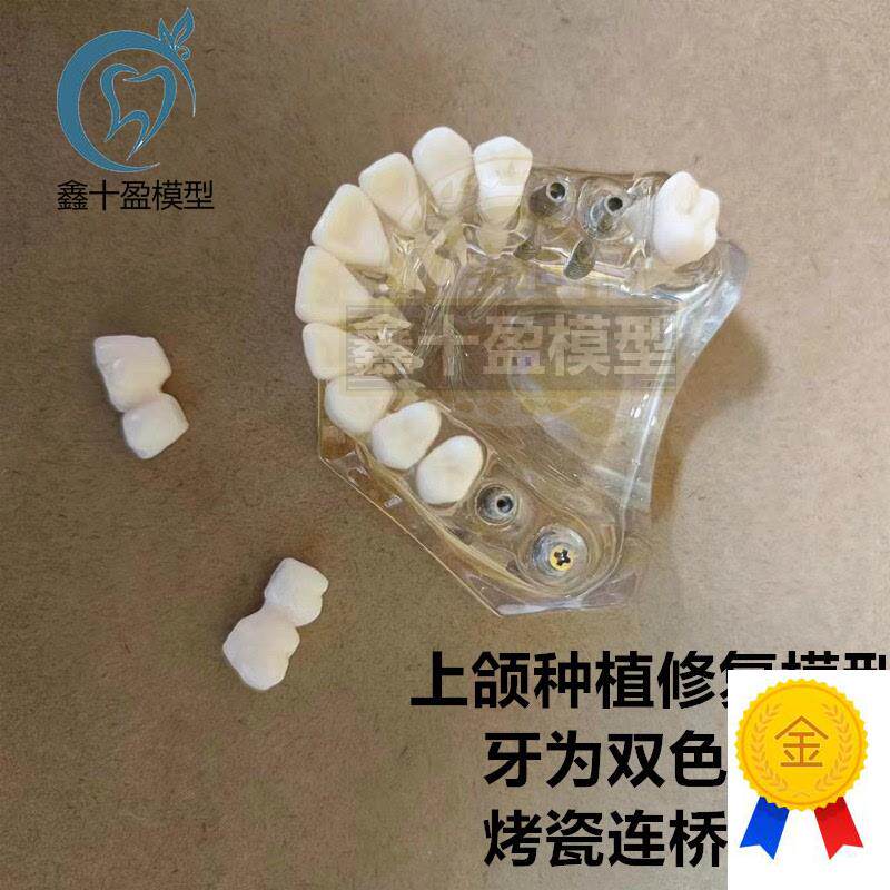 牙科种植模型2011上颌种植A解说义齿修复烤瓷连桥种植钉模型