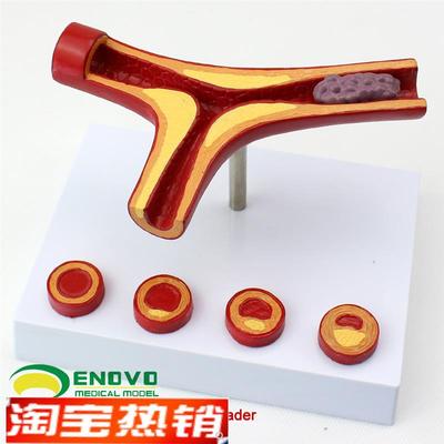 颐诺正品冠状动脉性心血管动脉硬化模型老年心脏模型血栓形成
