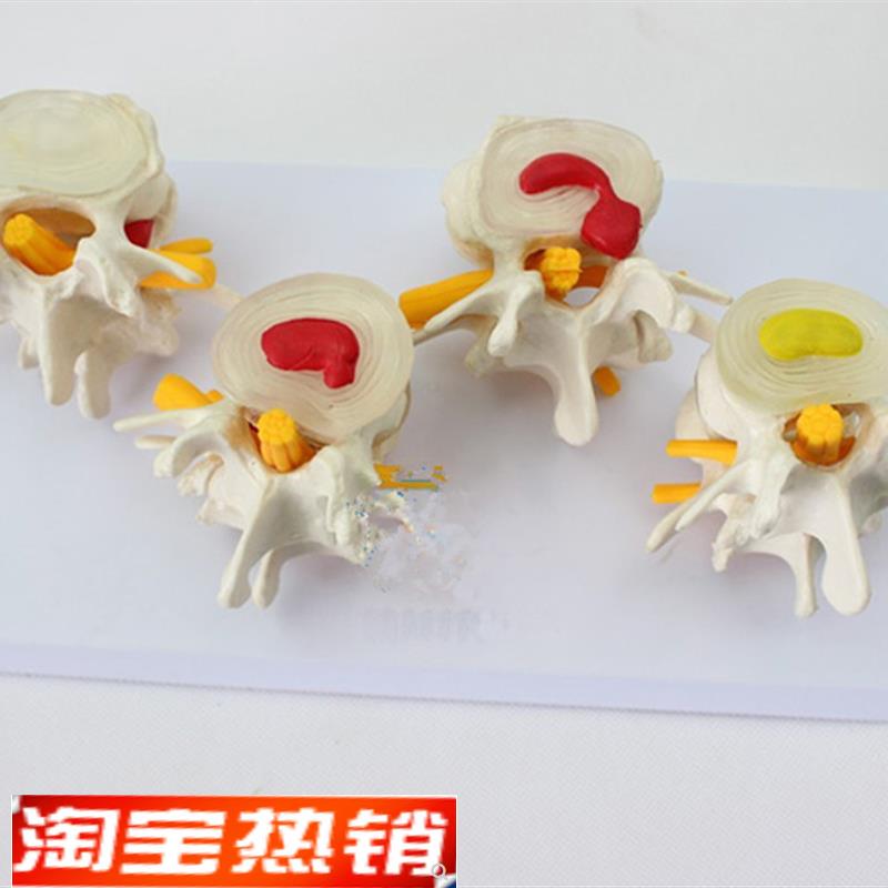 4阶段病态腰椎比较模型人体四个时期病变腰部脊柱脊椎模具标本