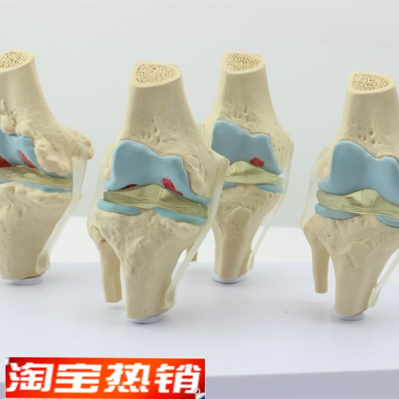 ENOVO颐诺人体病理膝关节模型 退行性血友病模型骨科管骨骼模型膝
