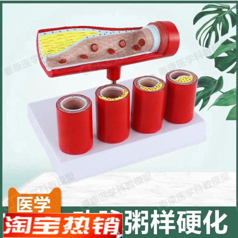 动脉血管模型内膜粥样斑块阻塞狭窄硬化医患药礼品血管壁层次解剖