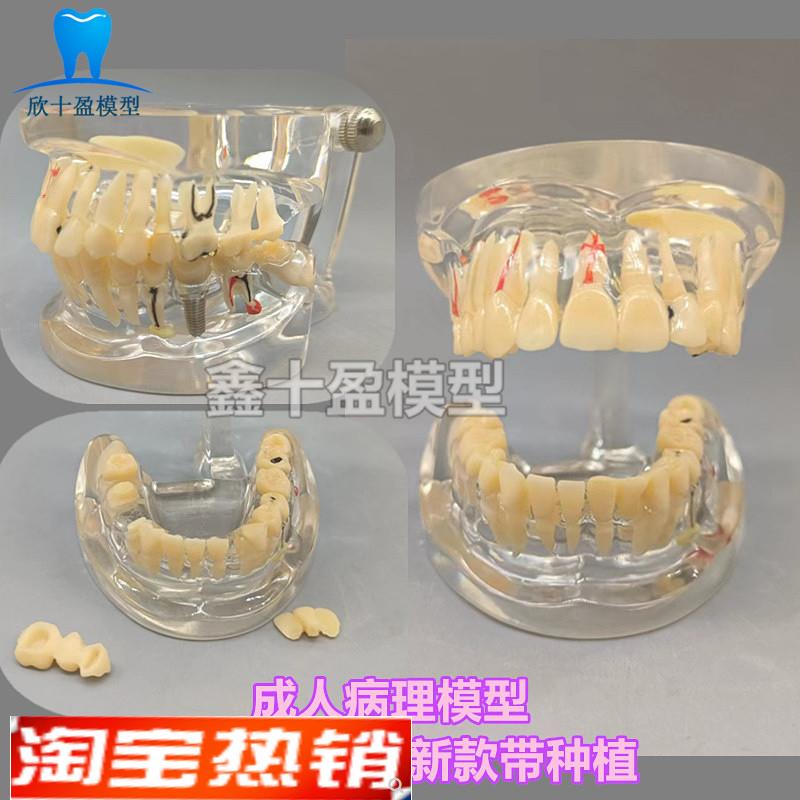 牙科牙齿病理模型成人全口牙模型牙模医患沟通教育教学种植修复C4