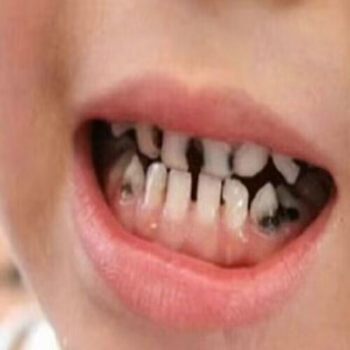 小儿虫吃牙疼儿童蛀牙疼防止蛀牙外用辅助熏包邮
