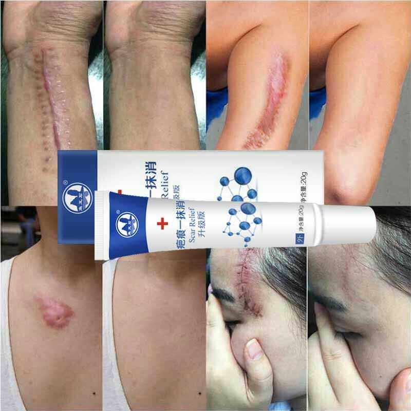 疤痕一抹消修复霜祛疤膏去点痣印痘印凹凸增生剖腹产手术伤疤正品