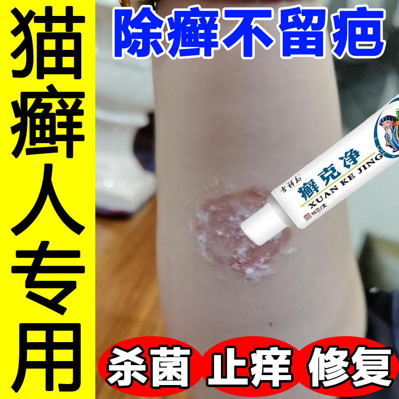 猫藓外用药人用猫癣专用药人得猫藓皮肤瘙痒癣斑真菌感染止痒药膏
