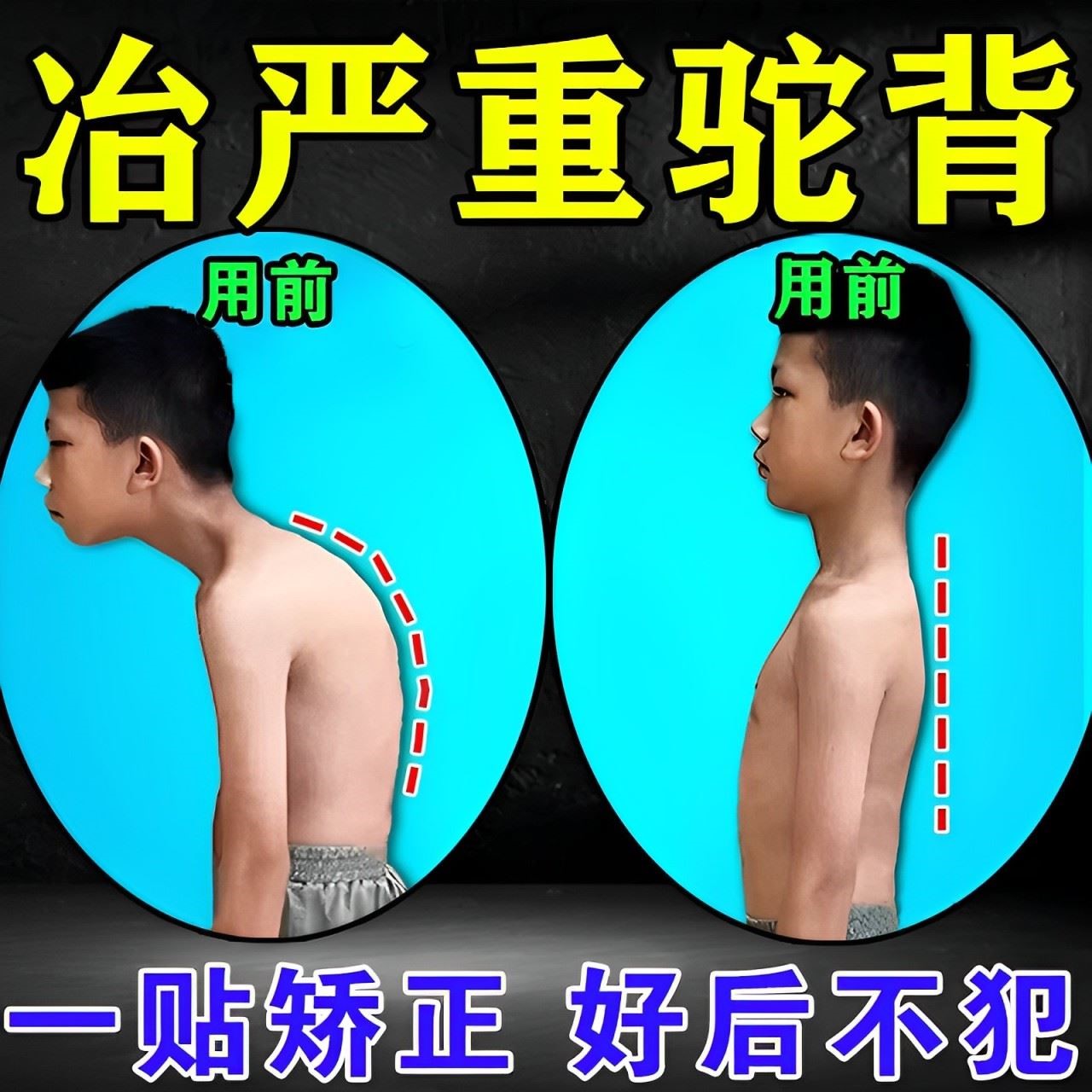 曲背矫正贴冶疗老人儿童驼背高低肩神器预防脊柱侧弯中药保健贴膏