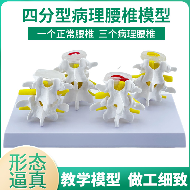 腰椎模型黄河病理骨骼模型教学