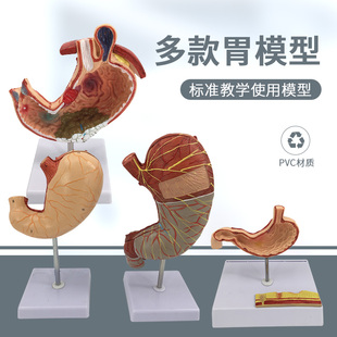 胃部疾病演示模型 人体胃解剖模型 病变模型 病理胃 胃 穿孔