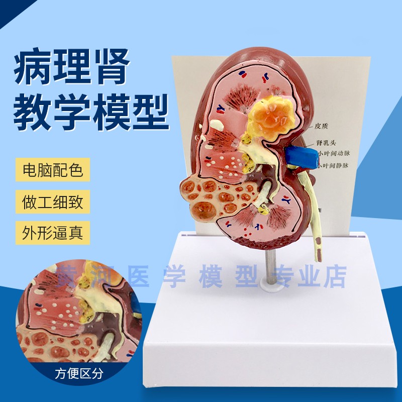 人体肾脏解剖模型 病理肾 病态肾脏解剖 泌尿科 医学肾脏模型病变