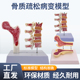 人体股骨骨质疏松解剖模型腿骨解剖面 病变腰椎模型 脊柱切面标本