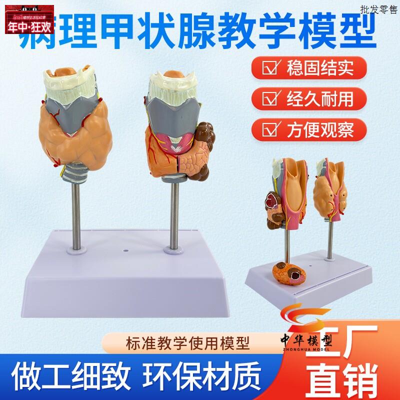 甲状腺病理模型甲状腺甲亢甲V低甲状腺肿留模型甲状腺病理模型