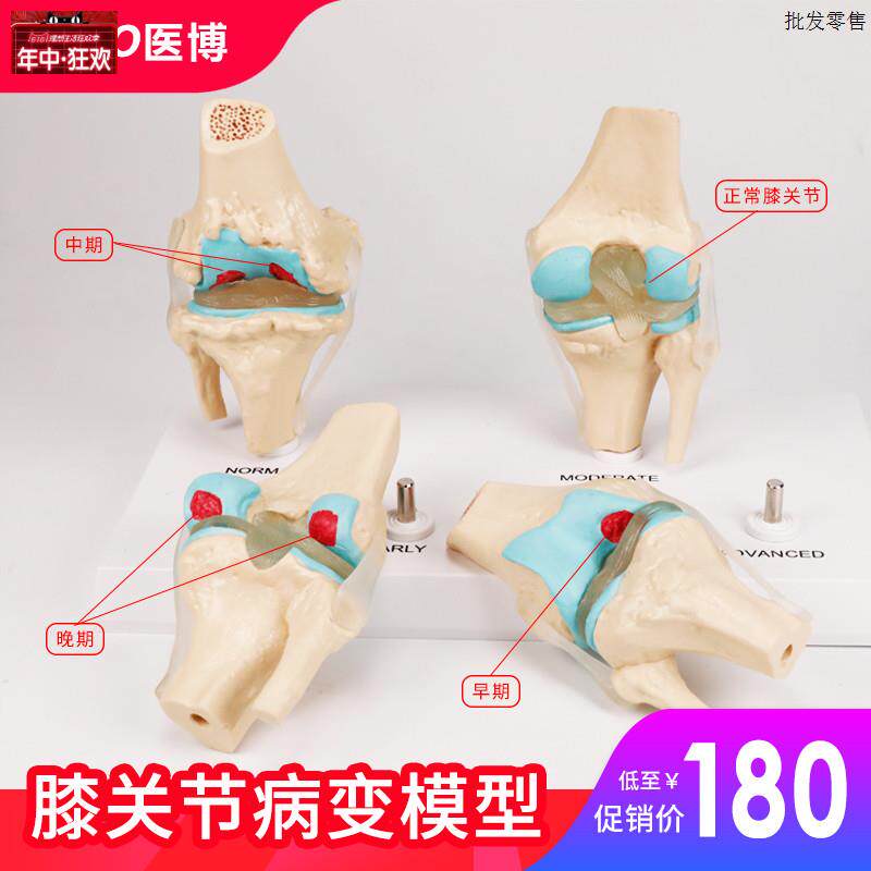 人体膝关节退行性/病变演示模型骨骼D模型功能性人体关节模型