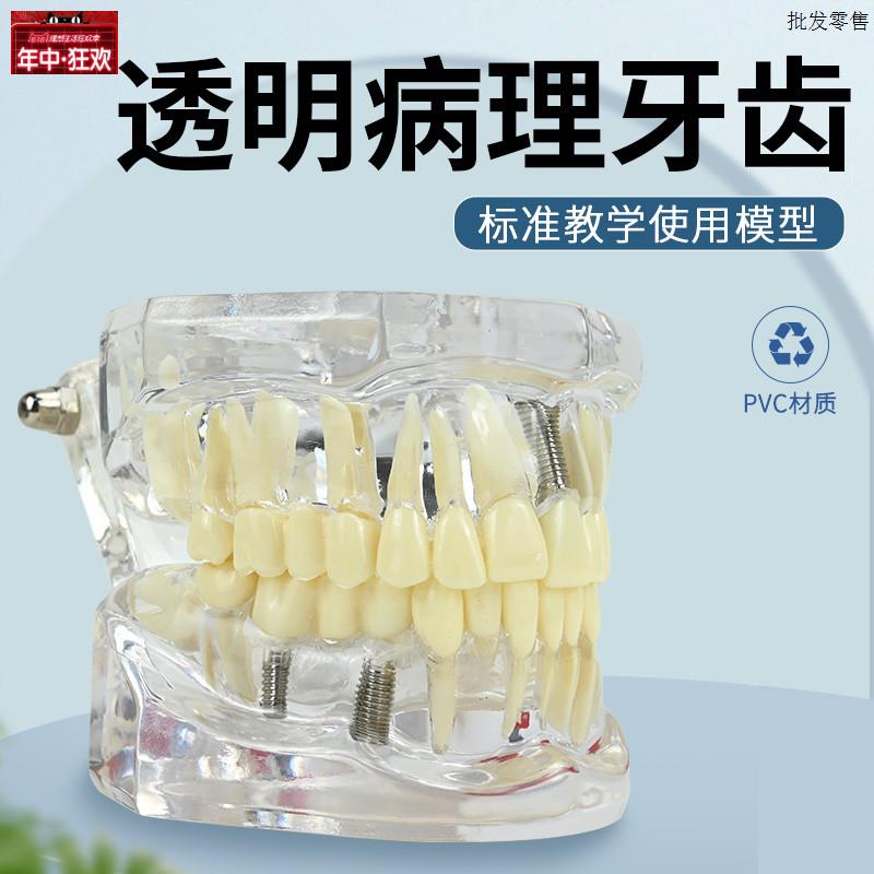 牙科修复模型口j腔科病理医患沟通教学修复体综合带神经可拆卸牙
