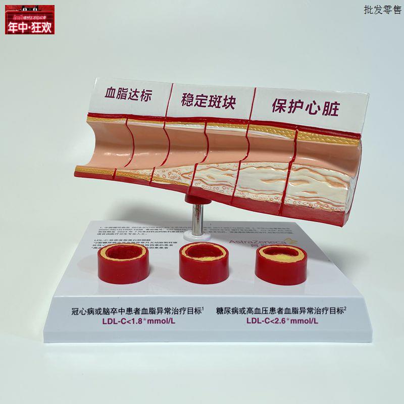 血管粥样脂肪斑块o动脉内膜不同年龄段血管变化栓破裂狭窄堵塞病