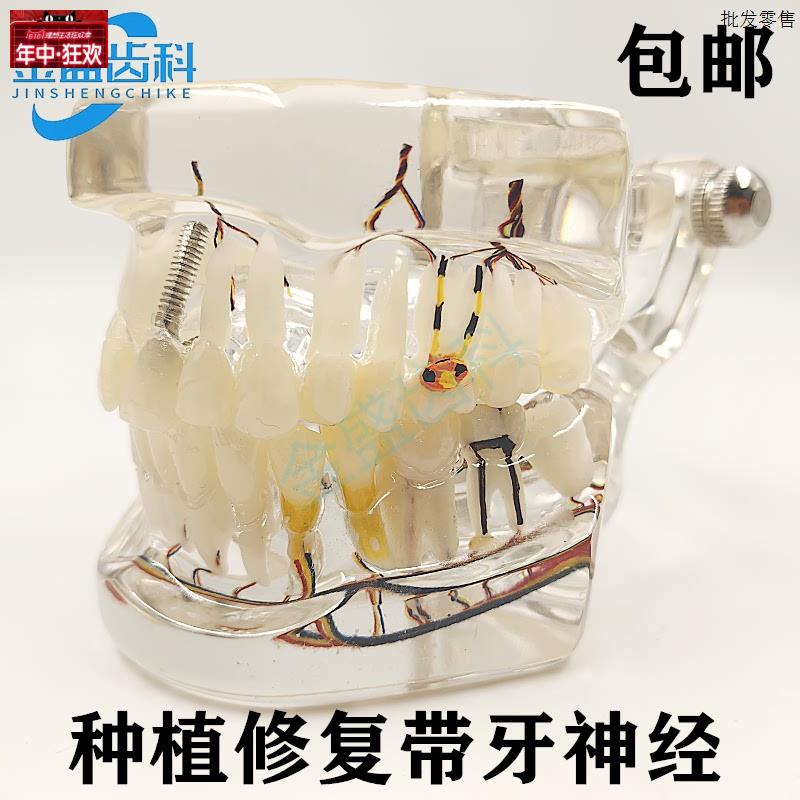 牙科口腔教学模型种植I修复体牙模型种植带牙神经模型医患沟通展