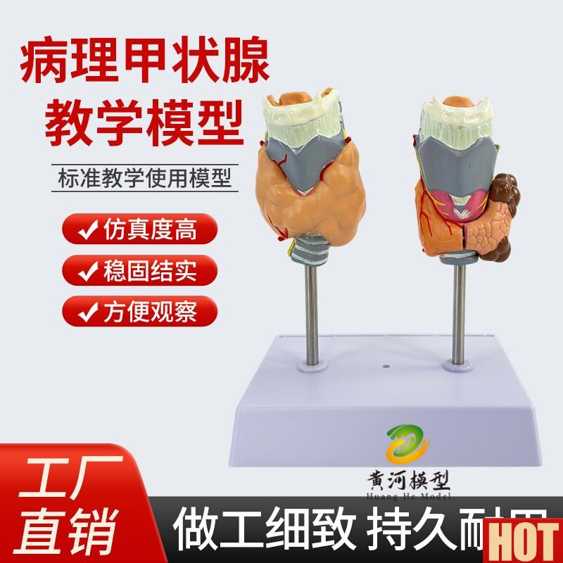 学彷真人体甲状腺病理模型 N病态喉头解剖甲状腺病变甲状腺标本