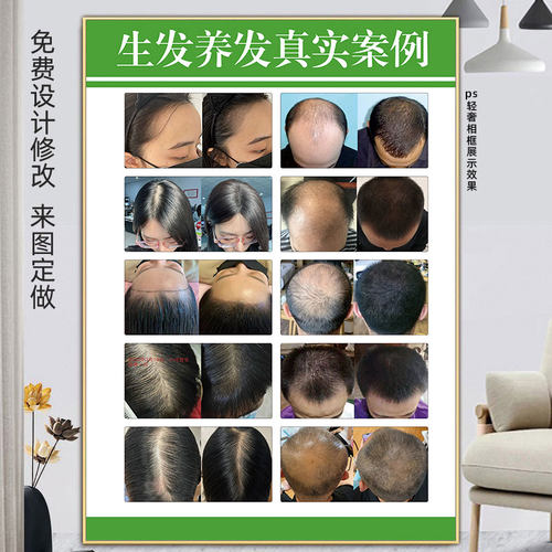 头皮状况对照图养发生发海报头疗