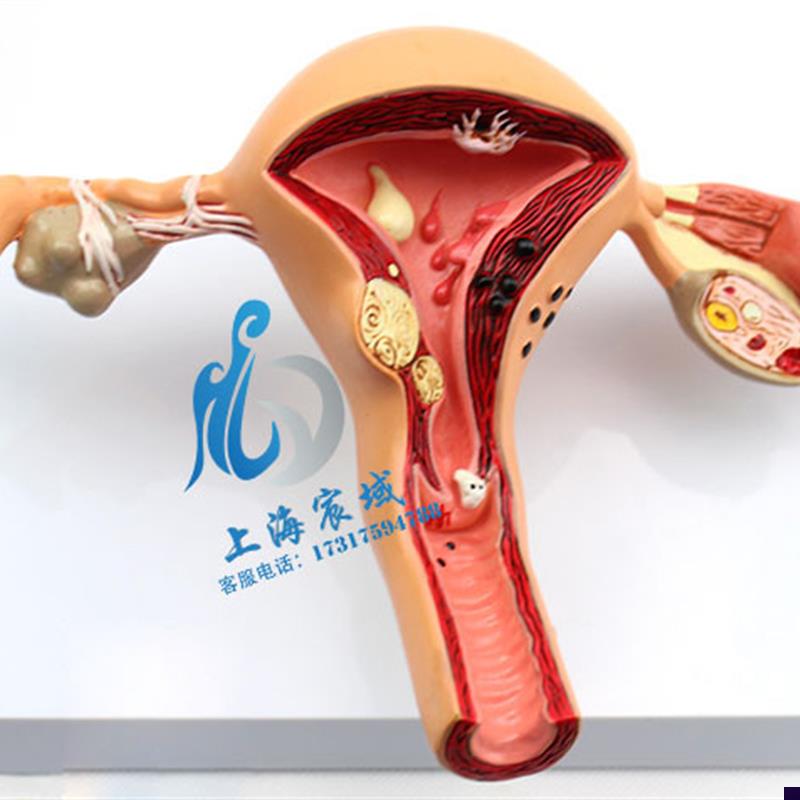 子宫卵巢病理病变模型生殖科女性内外生殖器T官模具教学病变