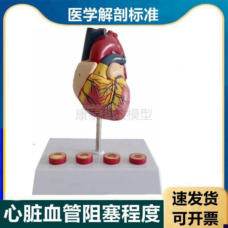 心血管模型冠状动脉粥样阻塞硬化程度H狭窄脂肪斑块内膜栓子医患