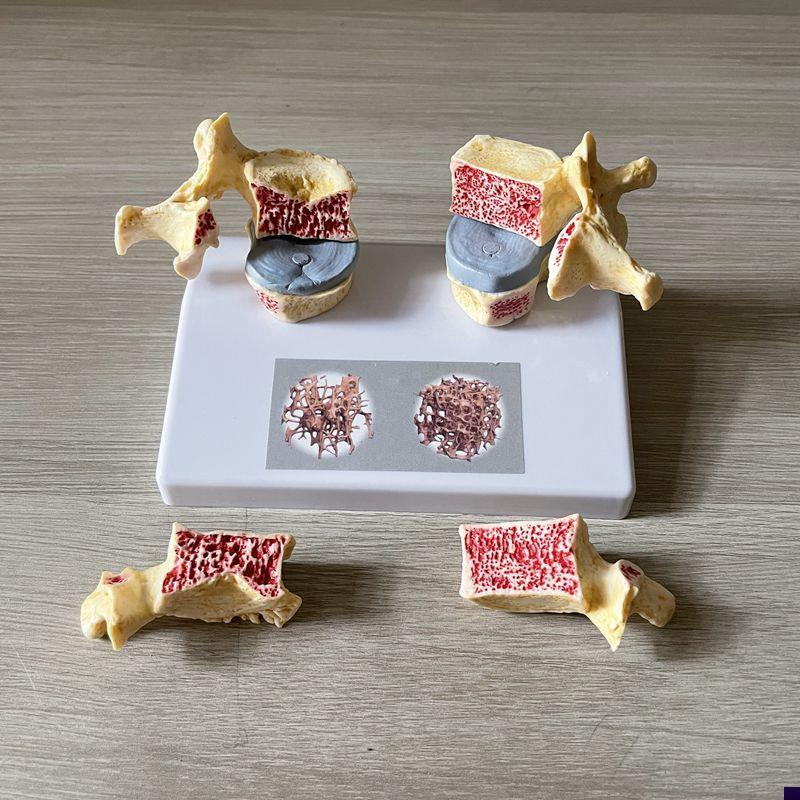 脊椎骨质疏松模型老年人骨骼仿真股骨头I密度腰椎变形劳损医患礼