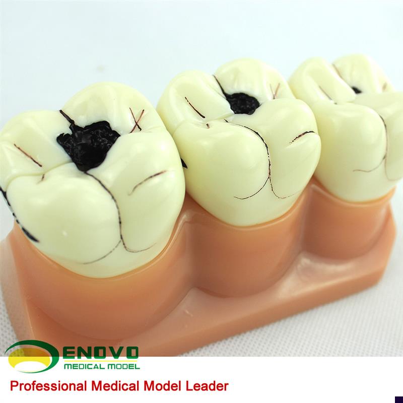 ENOVO颐诺口腔科牙齿龋齿模型C儿童虫牙蛀牙模型口腔健康儿童病理