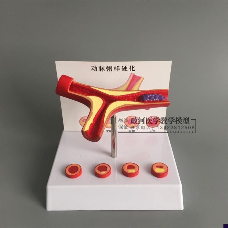 冠状动脉性心血k管动脉硬化模型老年心脏模型血栓形成
